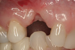 Figure 4  Note the vertical resorption.