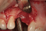 Figure 6  Mild vertical resorption present upon initial flap reflection.