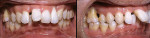Figure 2  Pretreatment intraoral photos. Note extreme overjet and overbite.