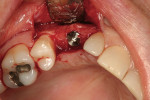 Figure 11  No. 6 implant in place after ridge expansion using special drills.