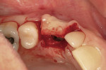 Figure 13  Guided gingival growth performed by laying flap and placing a 2-mm tall healing abutment on the fixture.
