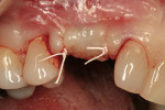 Figure 14  Increased vertical mucosal dimensions may be seen with the healing abutment underneath the sutured flap.