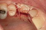 Figure 15  Increased lateral mucosal dimensions may be seen with the healing abutment underneath the sutured flap.