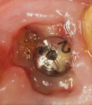 Fig 5. At 1 week postoperative, formation of a fibrin clot as a “barrier” has occurred, protecting the socket and implant surface from bacteria and debris.