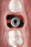Fig 2. Type B socket: Implant is stabilized but not completely contained by the interradicular bone; a gap is present between the implant and inner socket walls.