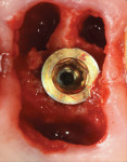 Fig 4. This case shows a 5-mm-diameter implant in a type A socket, with no graft placed in the root sockets.