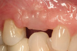 Figure 16  Buccal healing of site 1 month after instigation of guided gingival growth. The vertical tissue has been coronally repositioned.