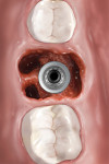 Fig 1. Type A socket: Implant is completely contained within the interradicular bone.