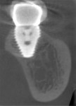 Fig 10. Type C extraction socket (Fig 7); a wide-diameter (8 mm x 9 mm) implant at 1 week postoperative healing (Fig 8); final restoration inserted (Fig 9); 5-year postoperative CBCT (Fig 10).