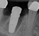 Fig 12. A 5-mm-diameter implant stabilized by septal bone in a Type B socket (Fig 11); on radiograph at implant placement, note socket gaps without graft (Fig 12); radiograph at 4 months postoperative/insertion of final prosthesis (Fig 13).