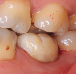 Fig 14. This is an example of a provisional screw-retained restoration (lower left second molar, No. 18) out of occlusion.