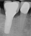 Fig 13. A 5-mm-diameter implant stabilized by septal bone in a Type B socket (Fig 11); on radiograph at implant placement, note socket gaps without graft (Fig 12); radiograph at 4 months postoperative/insertion of final prosthesis (Fig 13).