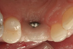 Figure 17  Palatal exposure of the healing abutment. No sign of infection was apparent.