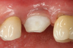 Fig 15. This image shows a customized temporary healing abutment. Note buccal orientation is marked.