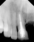 Fig 3. Preoperative radiograph of the maxillary right central and lateral incisors.