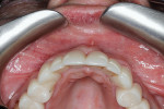 Fig 8. At 11 months, occlusal (Fig 8) and buccal (Fig 9) views with provisional restoration in place.