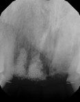 Fig 10. Periapical radiograph at 11 months.