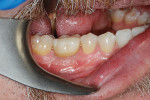Fig 19. Six months post-restoration, buccal view.