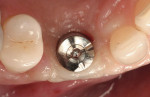 Figure  19  Acceptable buccal-lingual positioning of the implant may be appreciated from this occlusal view of the new healing abutment.  This view shows that there is still more finishing and polishing to be done to further refine the embrasure spac