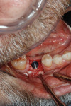 Fig 18. Occlusal view of implant placement.