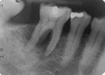 Fig 3. Intraoral periapical radiograph of mandibular right first molar. Presence of radiolucency around the third root, or RE,
can be noted.