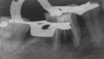 Fig 4. Master cone radiograph of mandibular right first molar after endodontic therapy.