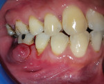 Fig 1. Periodontal abscess seen in relation to the mandibular right first molar.
