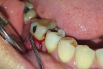 Fig 2. A pocket depth of more than 10 mm was revealed in the mid-buccal area.