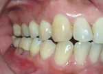 Fig 9. Buccal view at 6-month follow-up.