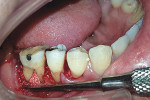 Fig 8. Clinical image after placement of bone graft in the furcation defect.