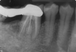 Fig 13. Intraoral periapical radiograph of tooth No. 30 at 9-month follow-up. Radioopacity around the distolingual root of tooth No. 30
showed continued bone formation/bone fill.