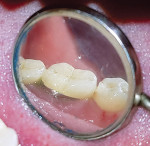 Fig 12. View of soft tissue on the lingual side of tooth No. 30 at 9-month follow-up.