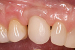 Figure 2  Buccal view of the final No. 6 crown. Papillary discrepancy remains on the mesial and distal; these spaces may fill with tissue as time passes.