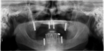 Fig 3. Post-operative x-ray shows the new implants.
