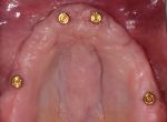 Fig 4. A locator-supported denture is fabricated.