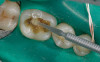 Figure 4  Rest position. Men should show an average of 1.91 mm and women 3.4 mm of central incisor at rest. Tooth No. 9 would be a good reference length for the patient in this photograph.