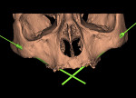 Fig 1. Computerized implant planning: anterior vision (Fig 1), view from below (Fig 2).