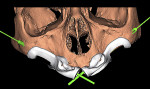 Fig 3. Preview of the surgical guide design: anterior vision (Fig 3), view from below (Fig 4).