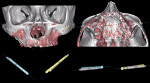 Fig 19. Superimposition of preoperative CT scan with postoperative CT scan allows the clinician to evaluate, with good approximation, the correspondence between the planning and the execution. All of the bone may be virtually eliminated to evaluate the difference in position between the planned implants and those actually placed. Various software programs may be used to measure the axial and angular discrepancies and calculate the average. In clinical cases A, B, and C (Fig 19, Fig 20, and Fig 21, respectively), the planned implants are in gray and the placed implants are in color. In clinical case D (Fig 22), the planned implants are in green and those placed are in blue.