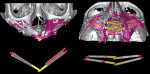 Fig 20. Superimposition of preoperative CT scan with postoperative CT scan allows the clinician to evaluate, with good approximation, the correspondence between the planning and the execution. All of the bone may be virtually eliminated to evaluate the difference in position between the planned implants and those actually placed. Various software programs may be used to measure the axial and angular discrepancies and calculate the average. In clinical cases A, B, and C (Fig 19, Fig 20, and Fig 21, respectively), the planned implants are in gray and the placed implants are in color. In clinical case D (Fig 22), the planned implants are in green and those placed are in blue.