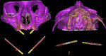 Fig 21. Superimposition of preoperative CT scan with postoperative CT scan allows the clinician to evaluate, with good approximation, the correspondence between the planning and the execution. All of the bone may be virtually eliminated to evaluate the difference in position between the planned implants and those actually placed. Various software programs may be used to measure the axial and angular discrepancies and calculate the average. In clinical cases A, B, and C (Fig 19, Fig 20, and Fig 21, respectively), the planned implants are in gray and the placed implants are in color. In clinical case D (Fig 22), the planned implants are in green and those placed are in blue.