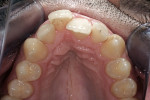 Figure 2  Preoperative occlusal view.