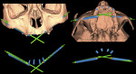 Fig 22. Superimposition of preoperative CT scan with postoperative CT scan allows the clinician to evaluate, with good approximation, the correspondence between the planning and the execution. All of the bone may be virtually eliminated to evaluate the difference in position between the planned implants and those actually placed. Various software programs may be used to measure the axial and angular discrepancies and calculate the average. In clinical cases A, B, and C (Fig 19, Fig 20, and Fig 21, respectively), the planned implants are in gray and the placed implants are in color. In clinical case D (Fig 22), the planned implants are in green and those placed are in blue.