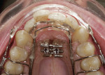Figure 3  Aligner in place after 6 weeks, occlusal view.