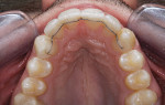 Figure 4  Occlusal view after 16 weeks.