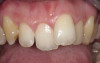 Figure 11  Crown lengthening was necessary to esthetically and functionally restore the patient in Figure 9 and 10. The incisal edge position was maintained and the teeth were restored to ideal length.