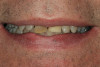Figure 16 and Figure 17 An example of properly contoured anterior restorations. Notice the convex profile, natural drape of the lip, and point of interaction with the lower lip.