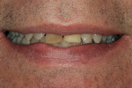 Figure 1   Preoperative smile exhibiting harsh edges, dark discoloration, and diastemas.