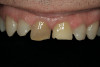 Figure 19 through Figure 21 The new restorations of the patient seen in Figure 18. The incisors now have a convex profile and lingualized incisal edge. Lip and phonetic comfort were normalized.