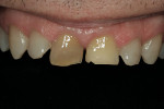 Figure 3   Retracted upper anteriors. Note the diastemas and extreme discoloration of tooth No. 8.